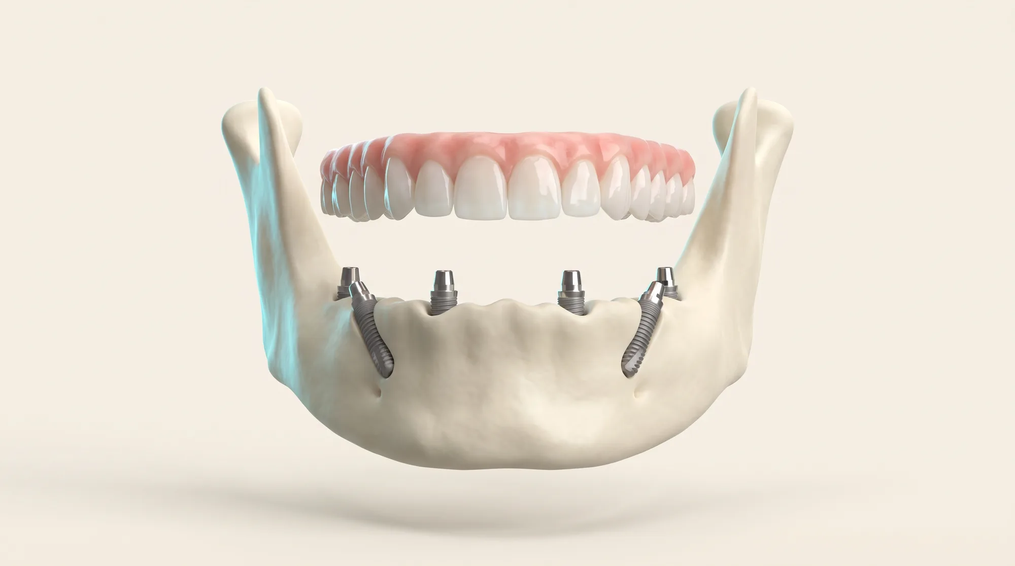 Feste Zähne an einem Tag: vier Implantate tragen einen kompletten Zahnbogen (All-on-4)